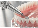 The image shows a dental model of a set of teeth with a dental implant in the center. The implant is made of metal and has a...