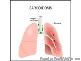 Sarcoidosis Lung Disease Expert In Jaipur – Dr. Virendra Singh