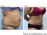 Liposuction Surgery Cost In Delhi - Dr Rajat Gupta