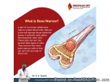 Bone marrow transplant in Hyderabadâ€”Dr. SK Gupta