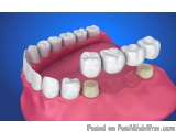 The image is a 3D rendering of a dental model of a set of teeth. The model is a representation of a human mouth with a set in...