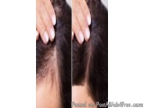 Trusted Hair Transplant Clinic in Thane With Expert Dermatologists