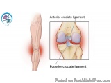 Is PCL surgery a major surgery? | Dr. Manish Maheshwari