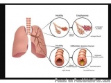 Expert Copd Doctor In Jaipur, Rajasthan – Dr. Virendra Singh