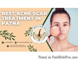 Best Acne Scar Treatment in Patna â€“ Perfect Skin and Hair Solutions